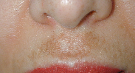 melasma